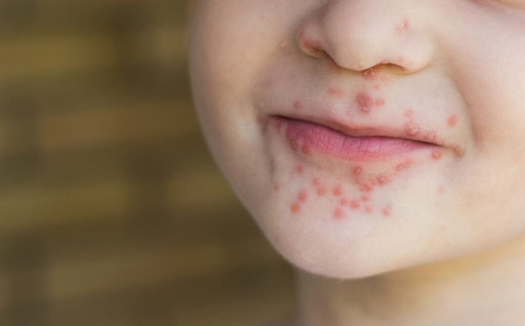 Hand Fuß Mund Krankheit – Ursachen, Symptome, Ansteckung, Verlauf, Behandlung und Vorbeugung hand fuß mund krankheit
